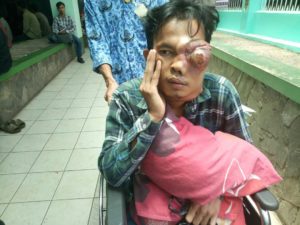 Yunus Penderita Kanker Mata Butuh Uluran Tangan Dermawan