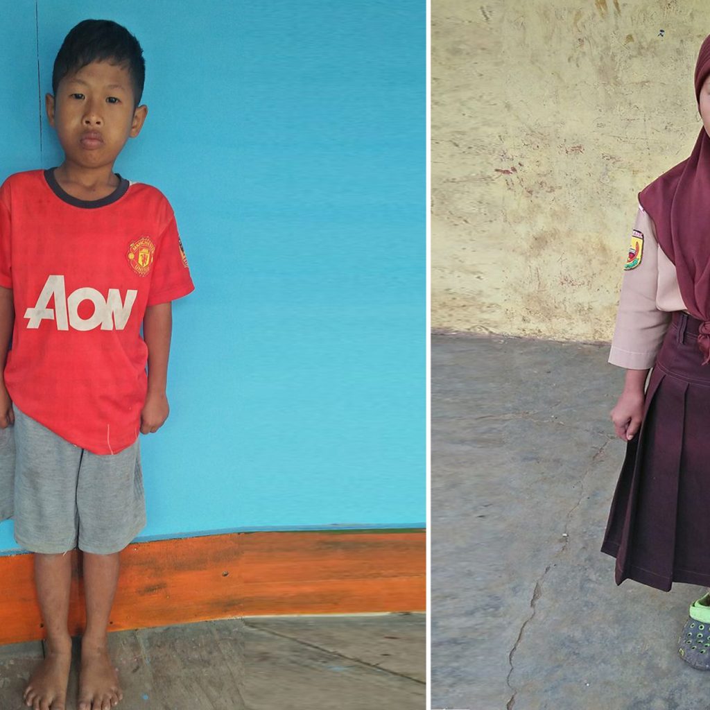 Dua Anak di Desa Margasari Yang Memiliki Kelainan Tubuh Butuh Perhatian Dari Pemerintah