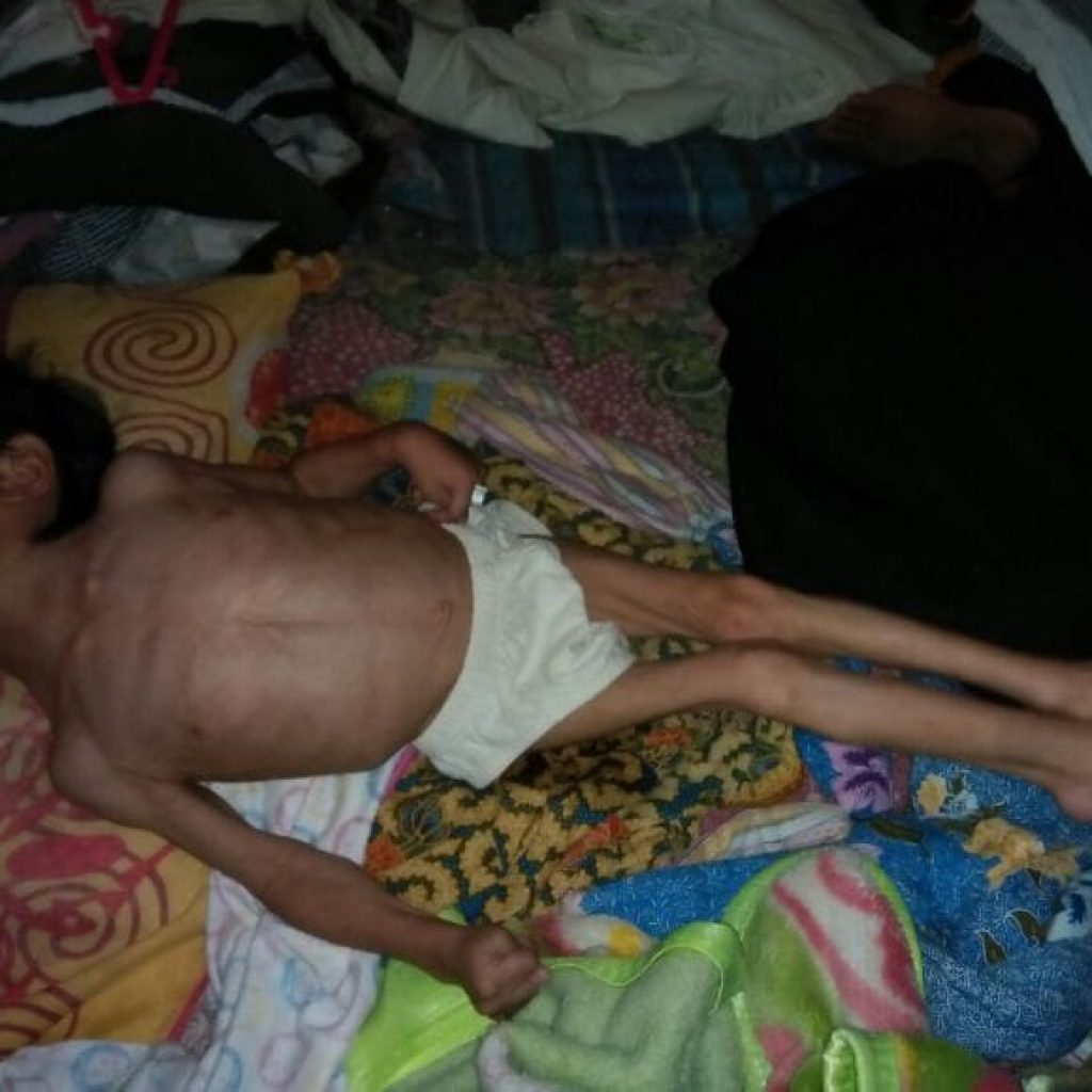 Silvia Putri Penderita Gizi Buruk di Garut Selatan Butuh Perhatian Pemerintah