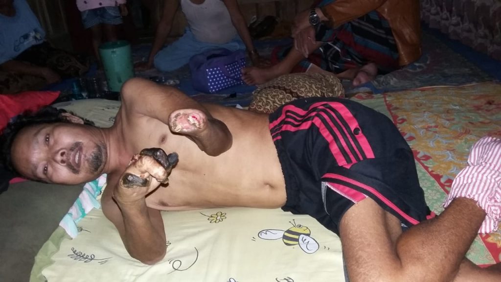 Kaki dan Tangan Membusuk, Warga Pasirhalang Terkena Penyakit Aneh