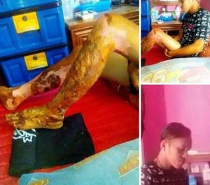 Alami Luka Bakar Serius, Adi Warga Cianjur Butuh Bantuan Pemerintah